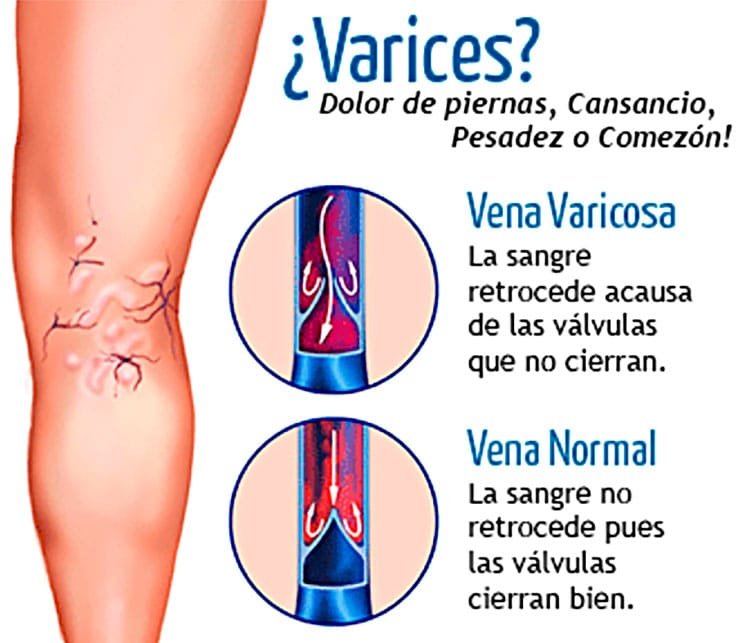 Causas de las Varices